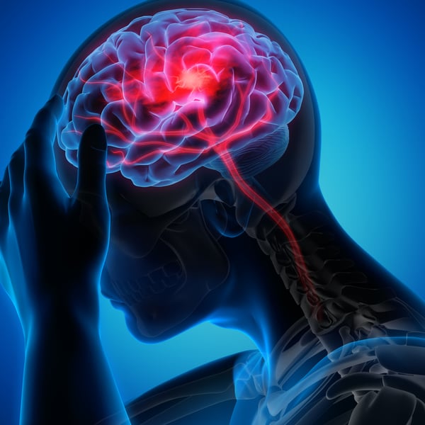 Stroke and the impact on Pacific People
